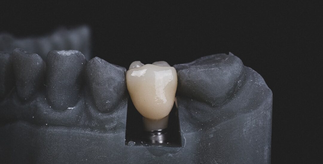 Photo Dental implants