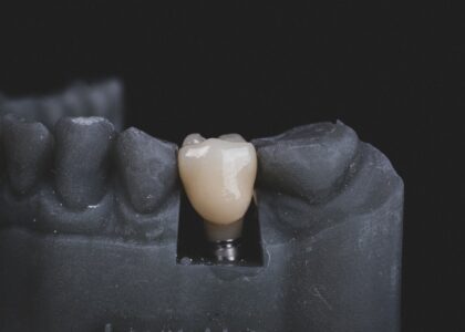 Photo Dental implants